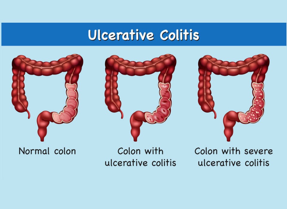 GANODERMA TRITERPENES ALLEVIATE COLITIS AND INHIBIT INTESTINAL CANCER