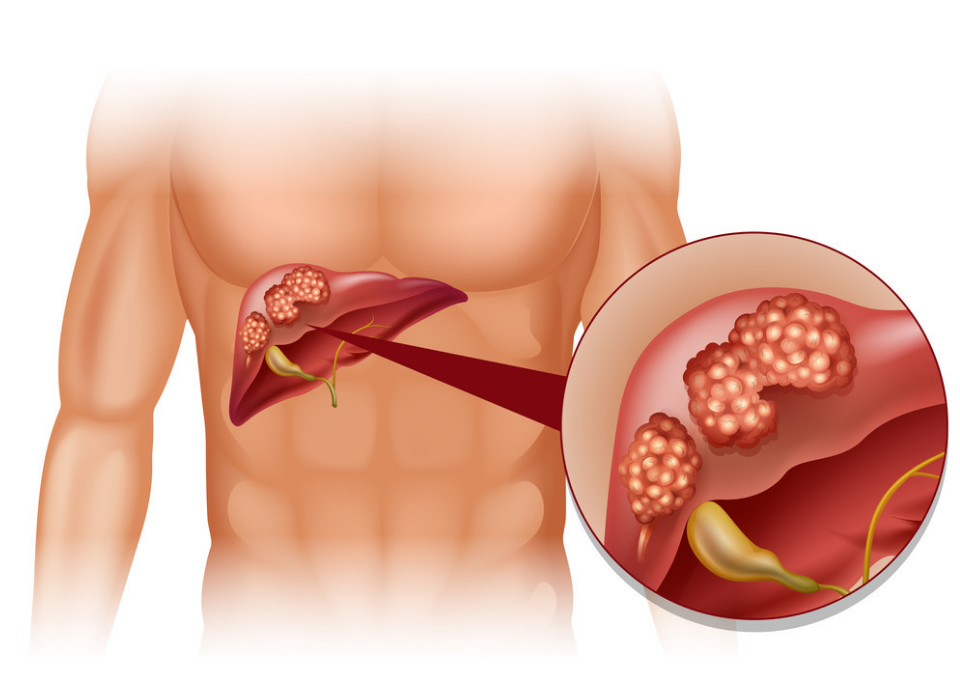 3 EFFECTIVE WAYS TO PREVENT LIVER CANCER