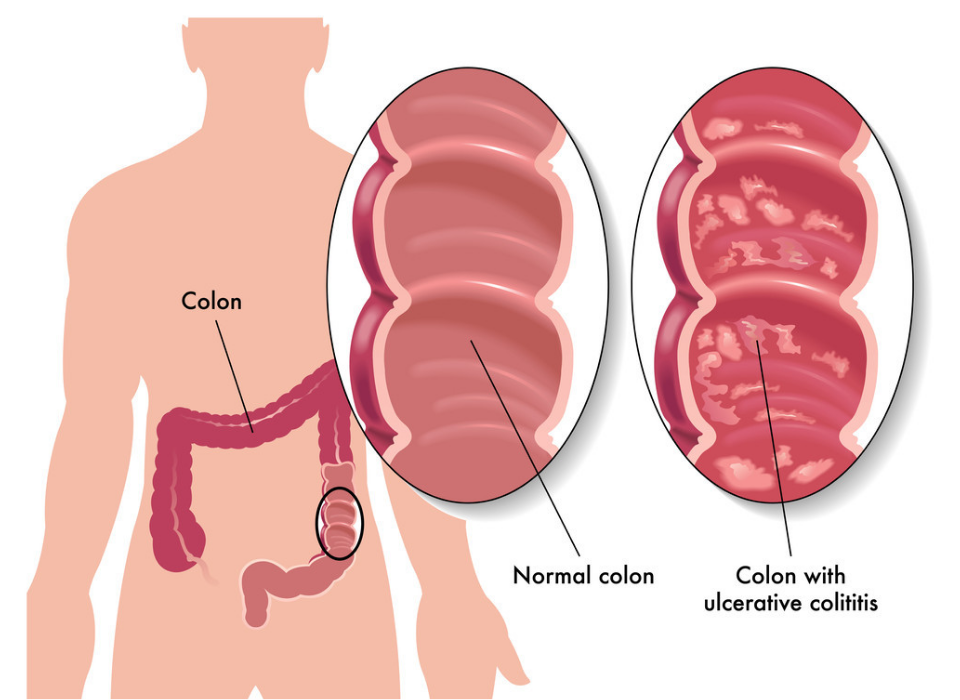 REISHI POLYSACCHRIDES AND COLITIS